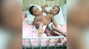 MAUTH Records Successful Separation of Conjoined Twins