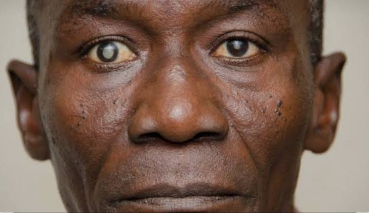 Over 24 Million Nigerians Living With Visual Impairment- OSN